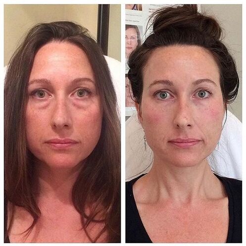 Girl before and after laser facial rejuvenation