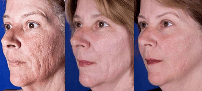 Result after a laser procedure to rejuvenate facial skin