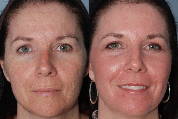 before and after hardware skin rejuvenation