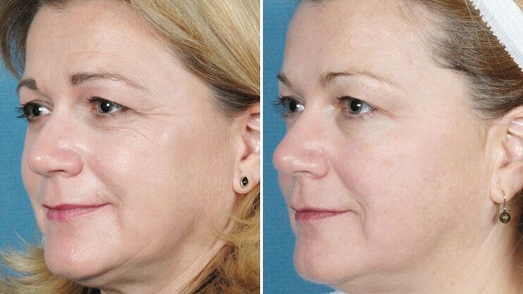photos before and after hardware skin rejuvenation